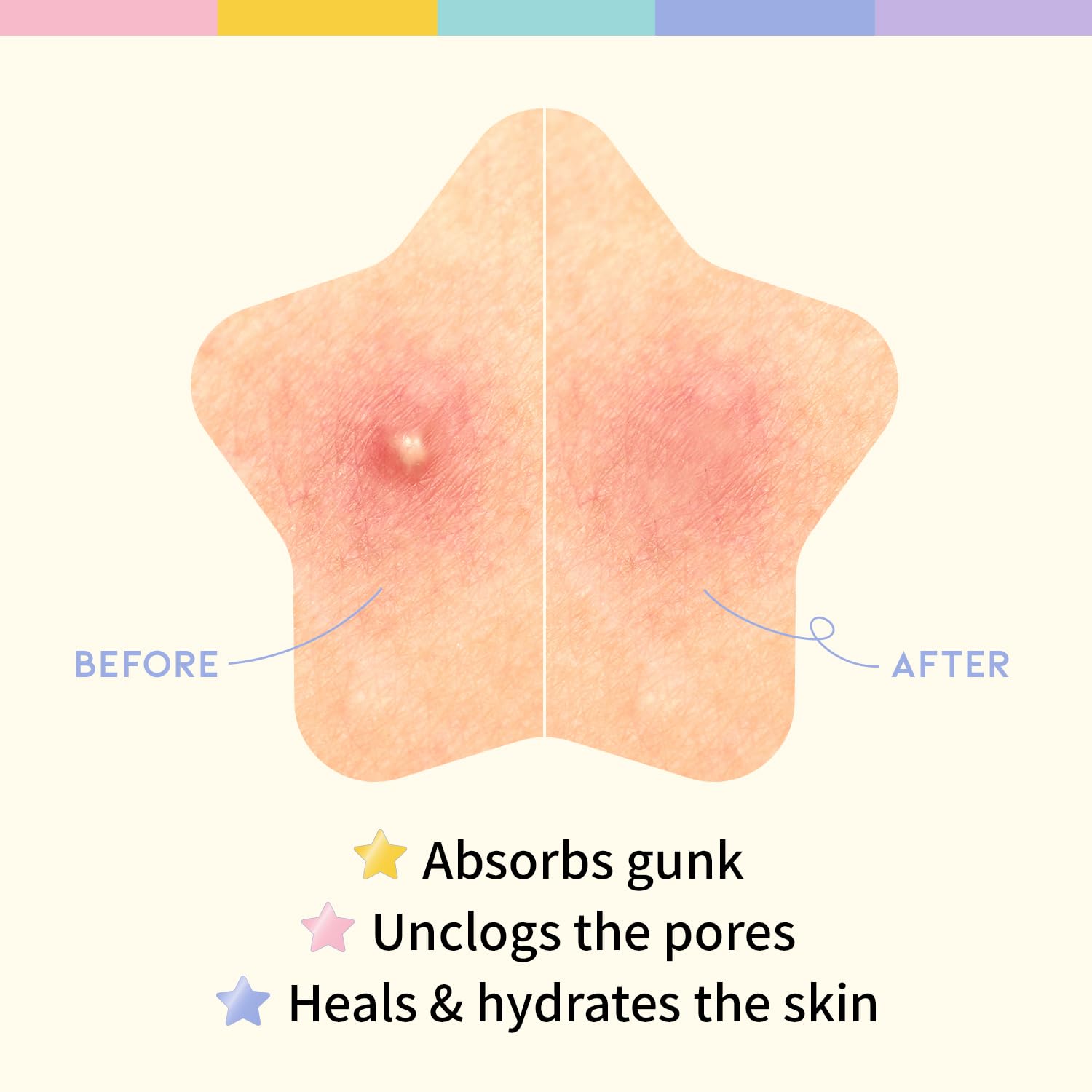 Star Spot Acne Pimple Patch